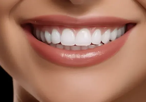 Bonding czy licówki?