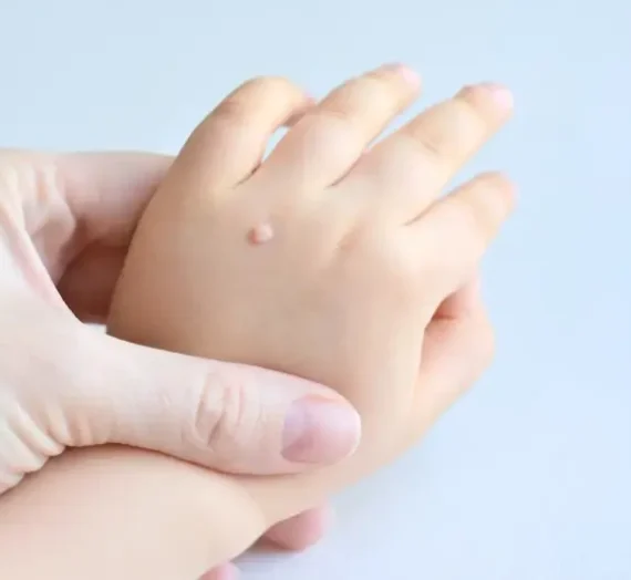 Co na kurzajki na dłoniach?