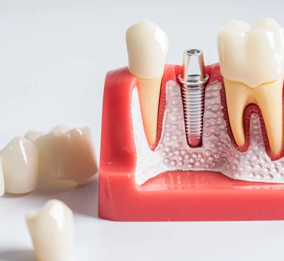 Ile kosztuje implanty?
