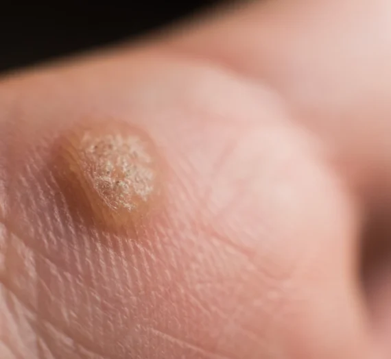 Ile kosztuje usunięcie kurzajki u dermatologa?