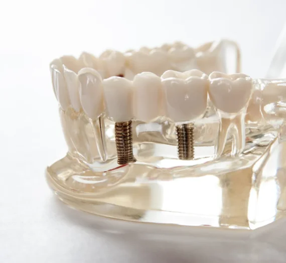 Implanty co to jest?