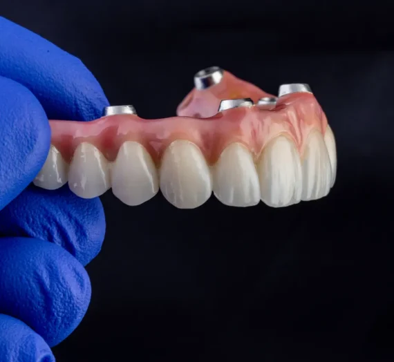 Implanty zębów co to jest?