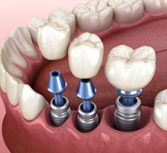 Implanty zębów gdzie najtaniej?