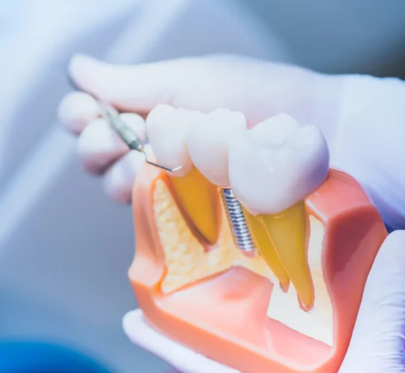 Jak dbać o implanty zębowe?
