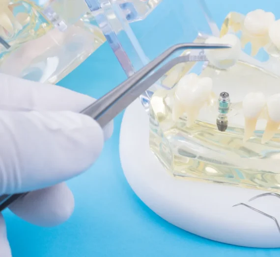 Jak wyglądają implanty zębów?