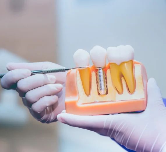 Na ile lat implanty zębów?