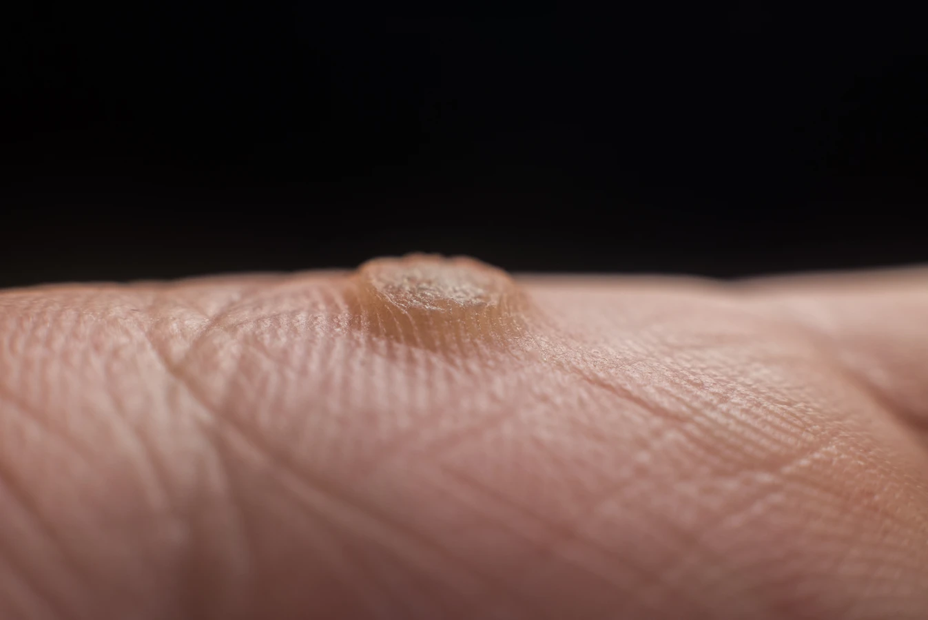 Podolog usuwanie odcisków