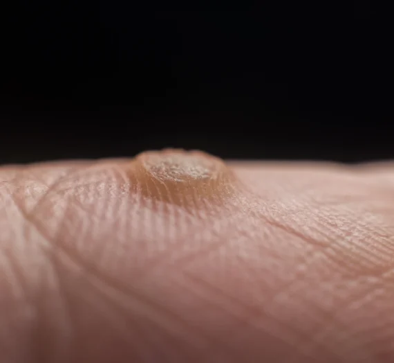 Z czego robią się kurzajki?