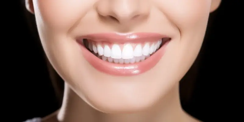 Co to licówki na zęby?