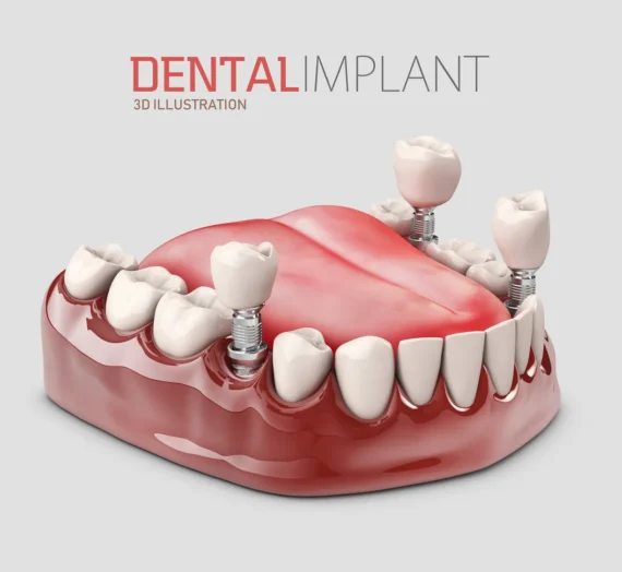 Proste i skuteczne wybielanie zębów.