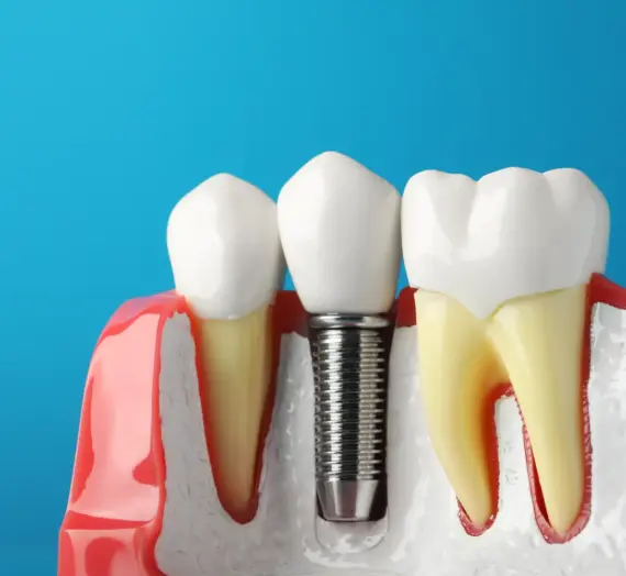 Najlepszy licówki Szczecin