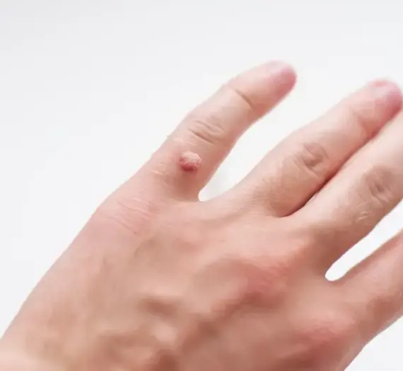 Jak wygląda rdzeń kurzajki?