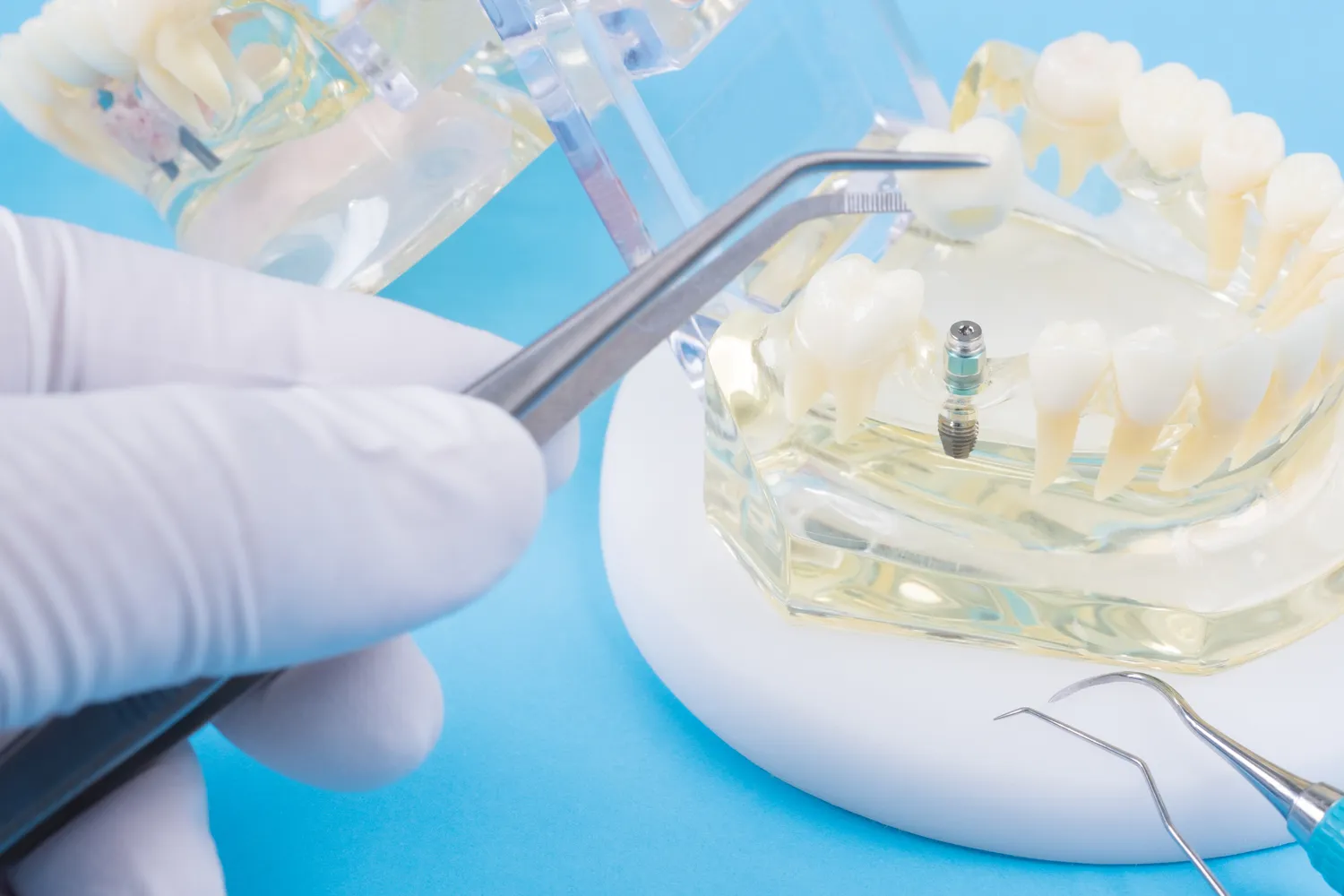 Zęby w jeden dzień Szczecin