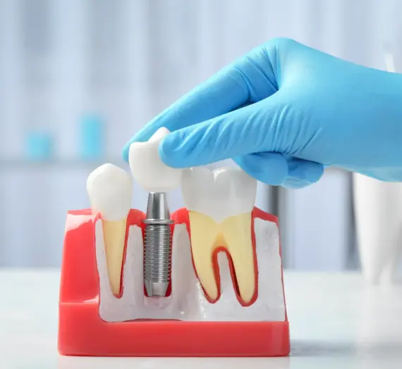 Implanty zębów Szczecin