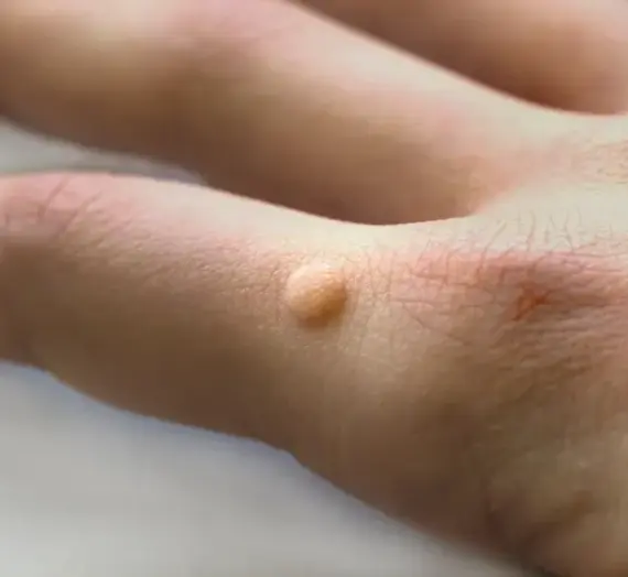 Jaskółcze ziele na kurzajki jak stosować?