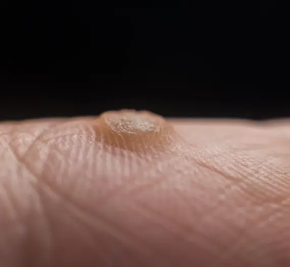 Od czego się robią kurzajki?